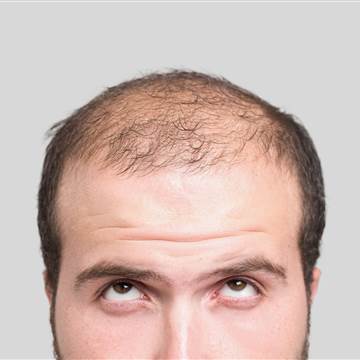baldness treatment